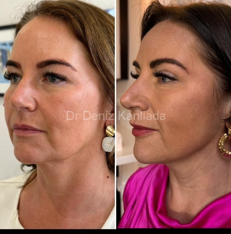 What is Endolift® And How Does It Help Improve Your Appearance? Unveiled